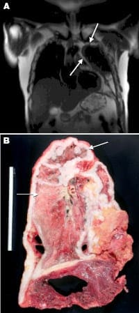 Mesothelioma MRI of the Lung MRI of lung showing malignant mesothelioma of pleural space